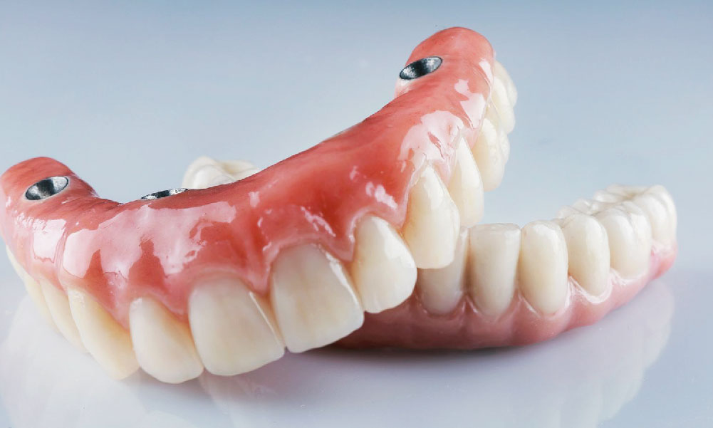 Servicios Odontologicos_Odontosonrisas - Implantes Dentales Chile Servicios Odontologicos_Odontosonrisas - Implantes Dentales Chile